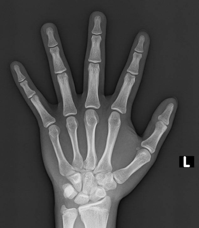 성장판 X-ray